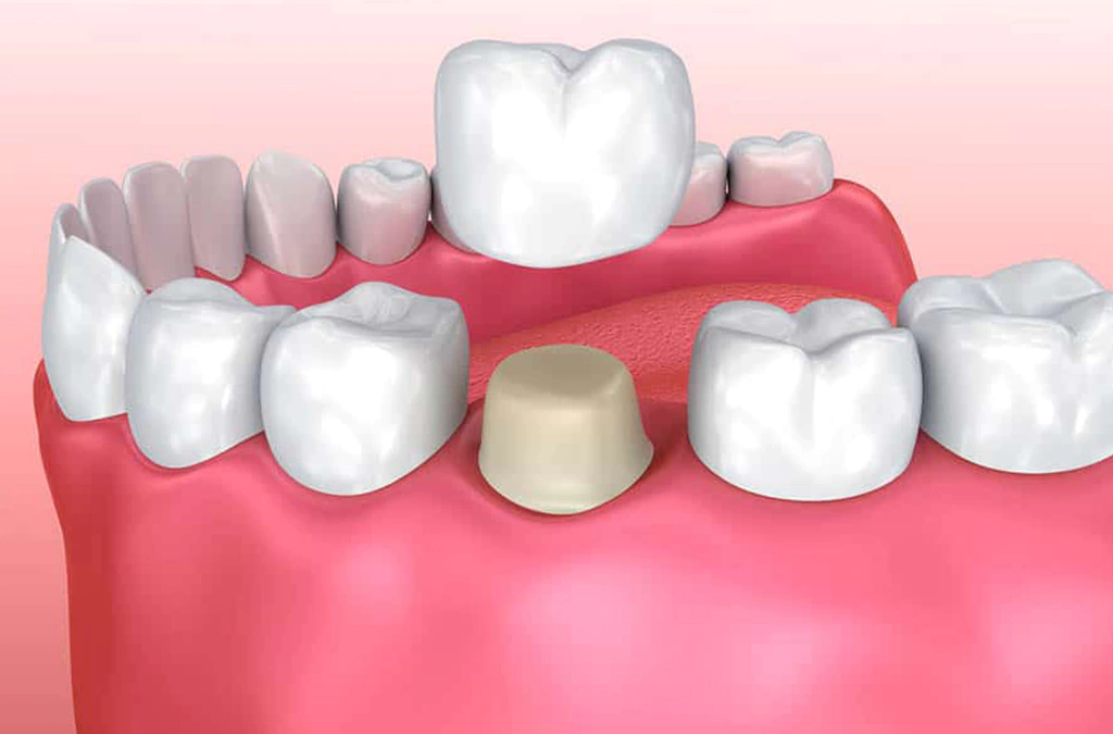 dental-crowns-tarneit-guide