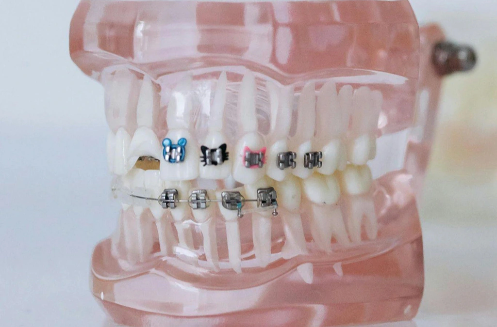 model of teeth with metal braces to illustrate orthodontic treatment