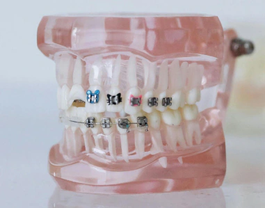 model of teeth with metal braces to illustrate orthodontic treatment