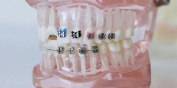 model of teeth with metal braces to illustrate orthodontic treatment 