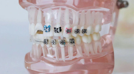 model of teeth with metal braces to illustrate orthodontic treatment