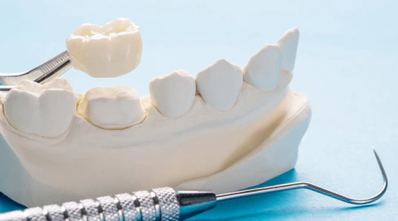 dental-crown-procedure-tarneit